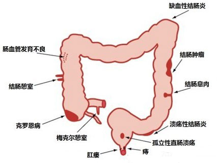 消化道出血